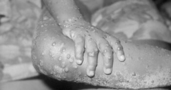 Grenadaโs Health Ministry Monitoring Reports Of Monkeypox Outbreak Overseas