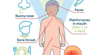 MINOR INCREASE IN COXSACKIE VIRUS (HAND, FOOT AND MOUTH DISEASES)